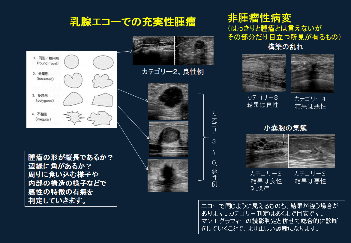 乳腺嚢胞、乳腺腫瘤疑いって？