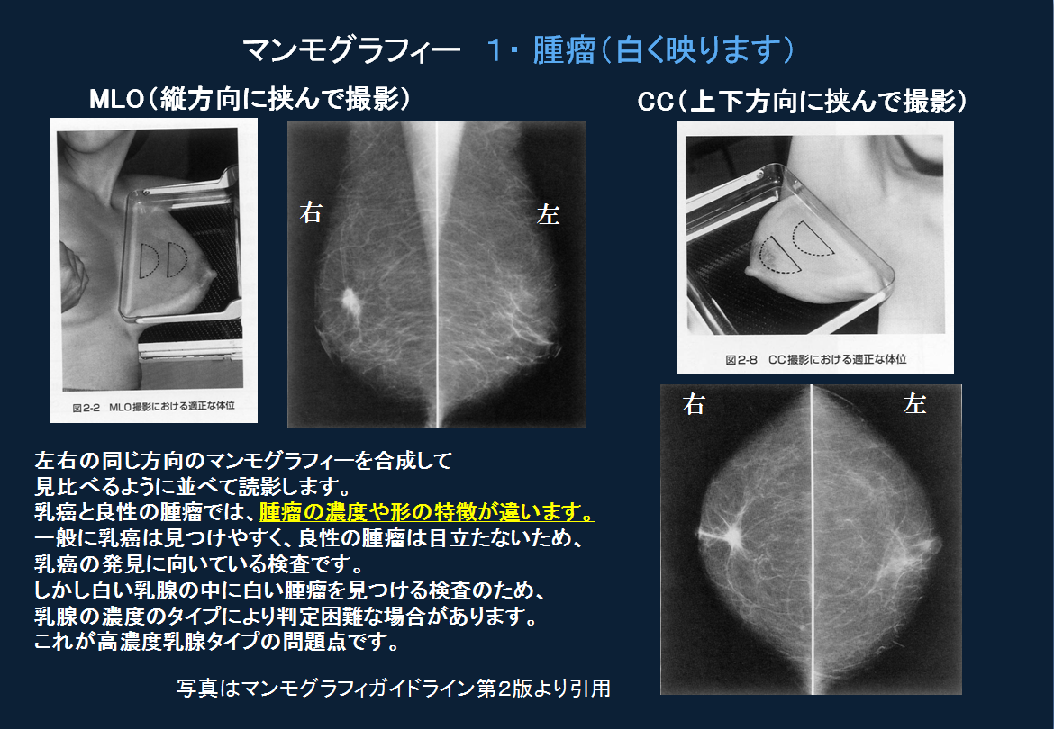 高濃度乳腺って？