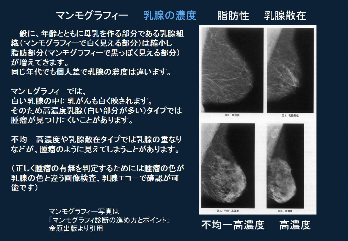 高濃度乳腺って？