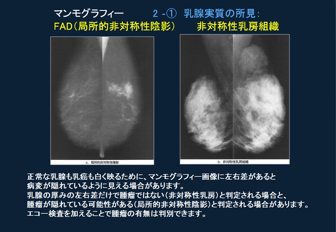 高濃度乳腺って？