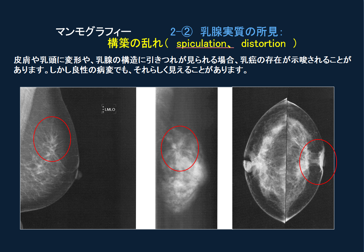 マンモグラフィーでみつかる乳がんって？