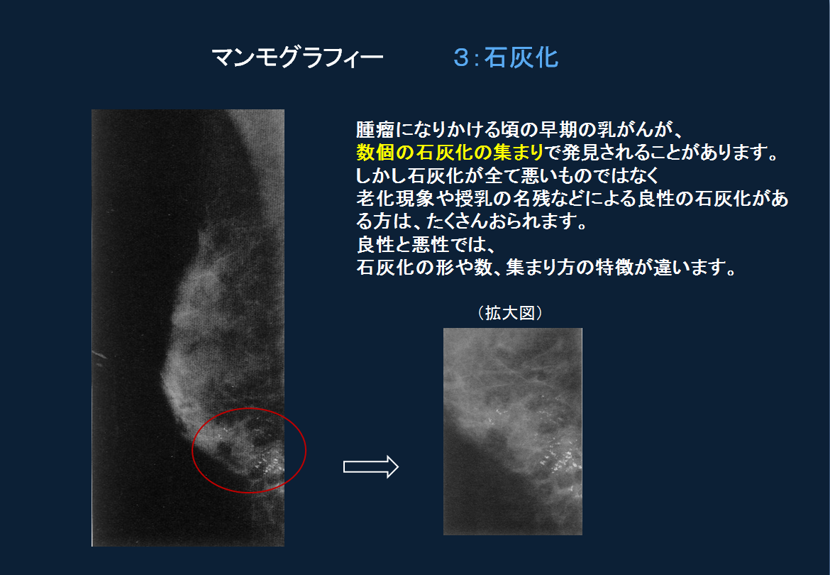 マンモグラフィーでみつかる乳がんって？